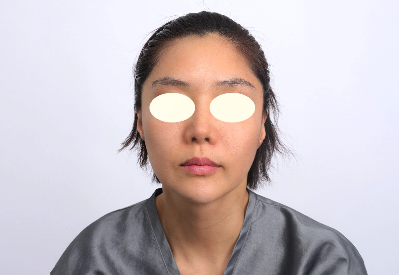 볼 모공 시술 후