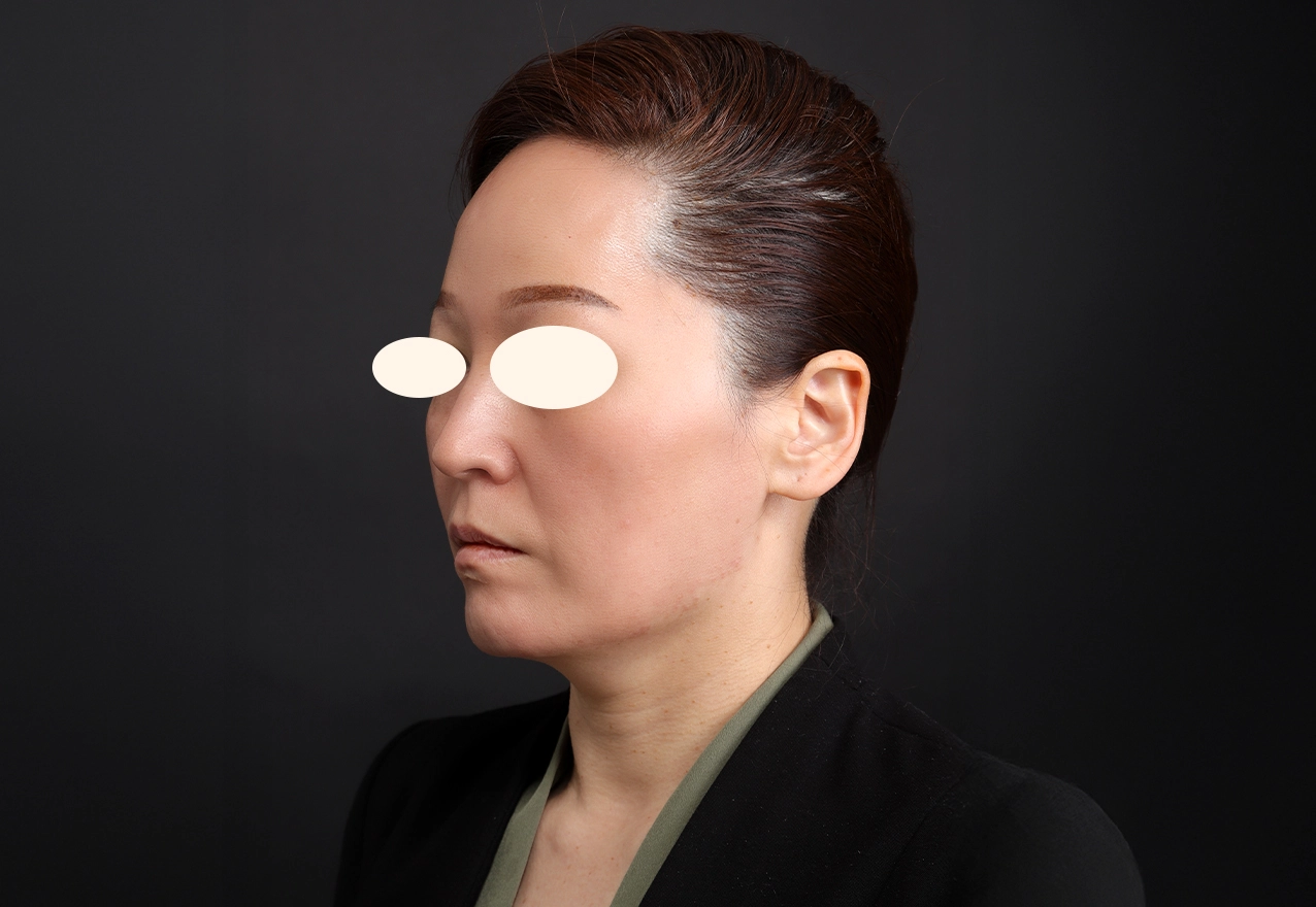 CASE 02 시술 후 약 2개월(참고)