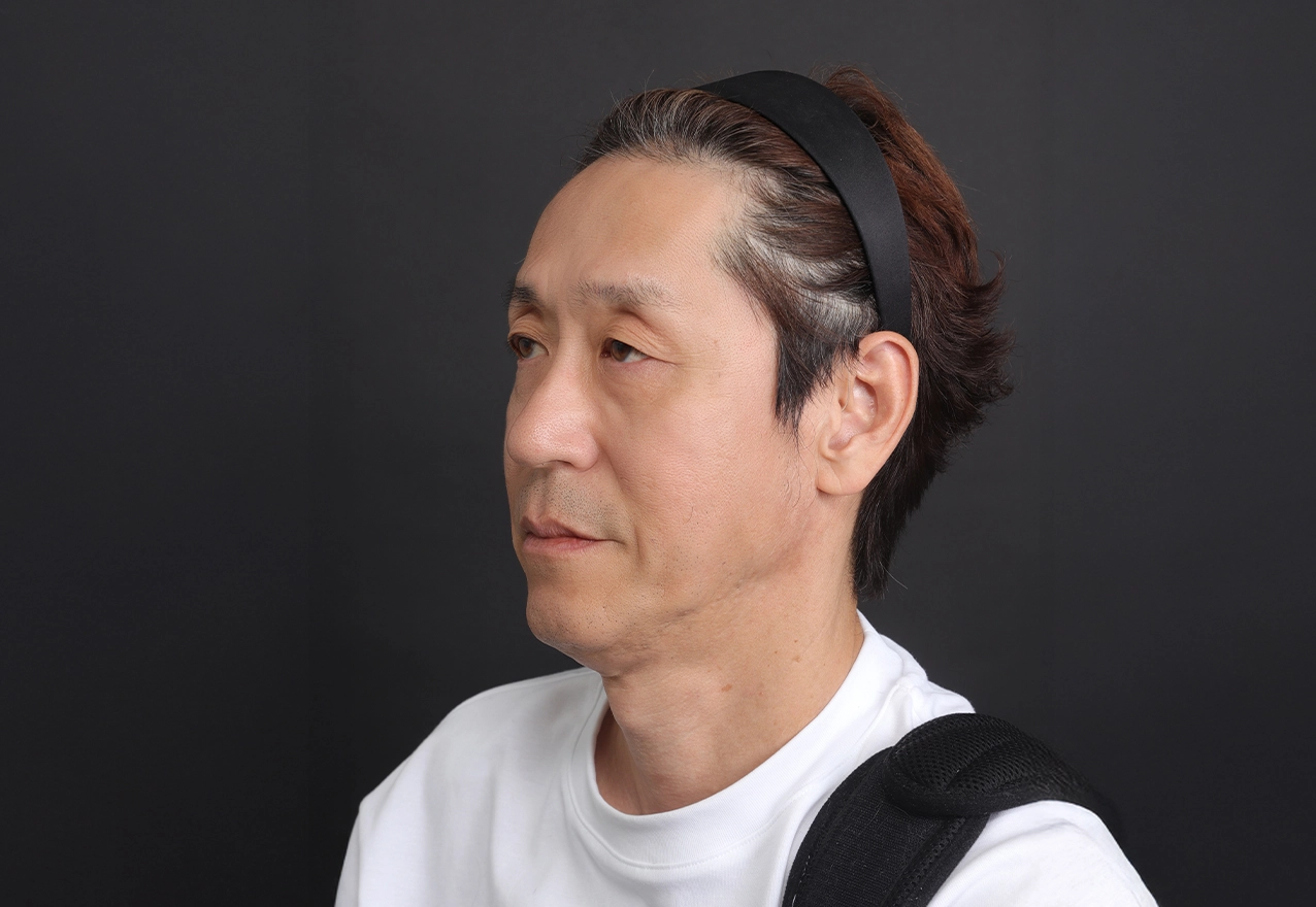 CASE 01 58세, 미시술·무수술, 자가재생 1회+울트라클리어 1회 복합 후 약 2개월(참고)