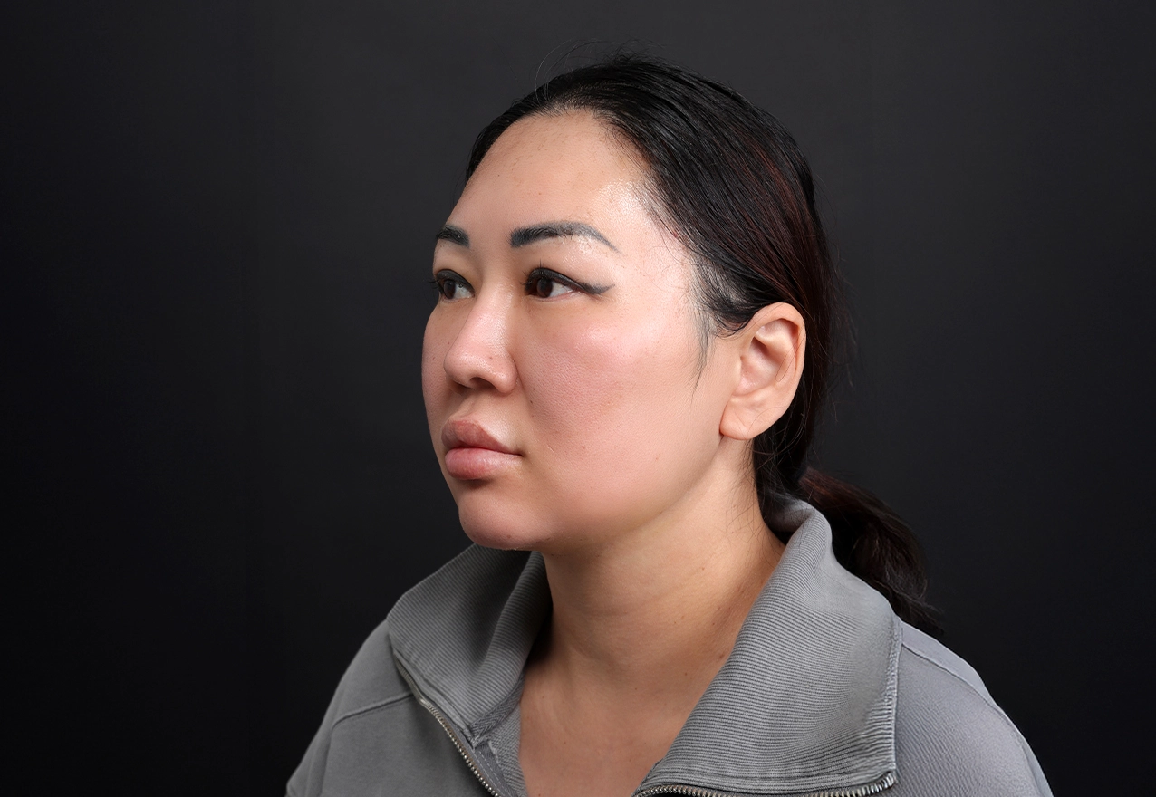 CASE 03 시술 후 약 2개월(참고)