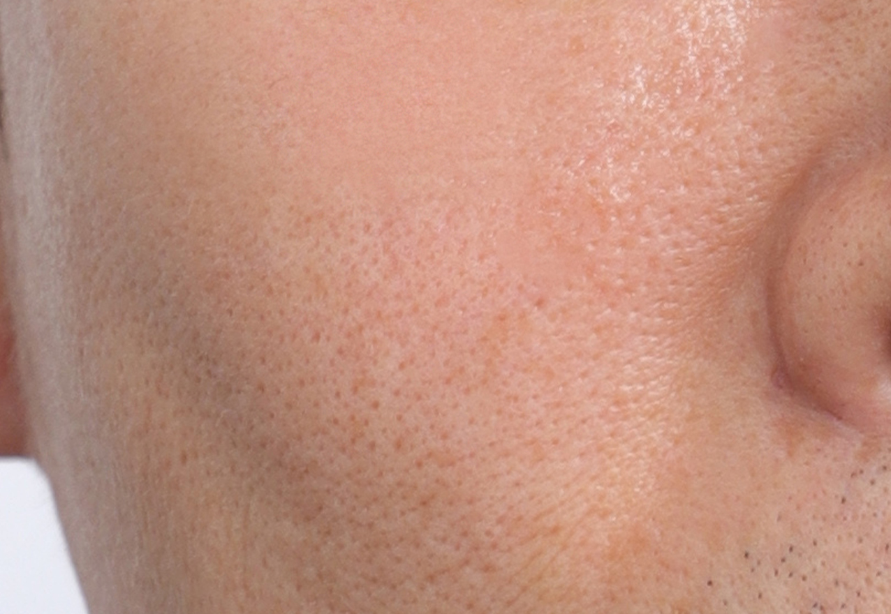 흉터 시술 후 케이스 1