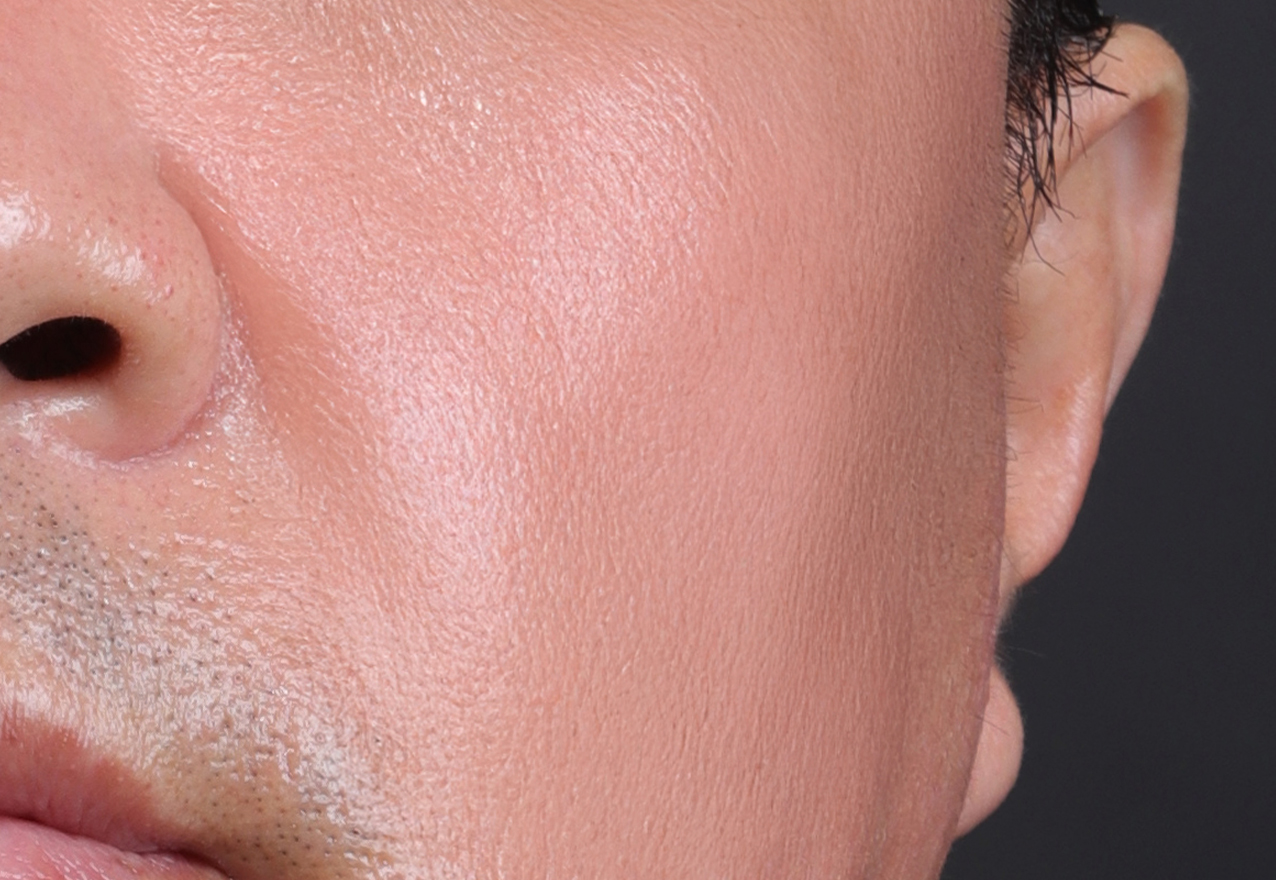 흉터 시술 후 케이스 2