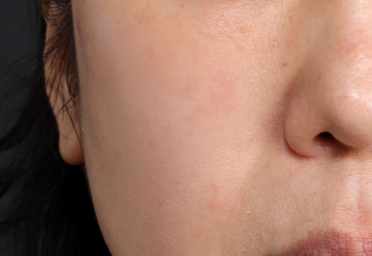 흉터 시술 후 케이스 3