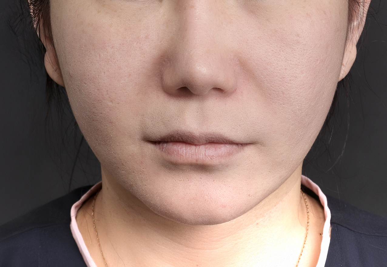 여드름 흉터 시술 후 (이미지 교체 예정)