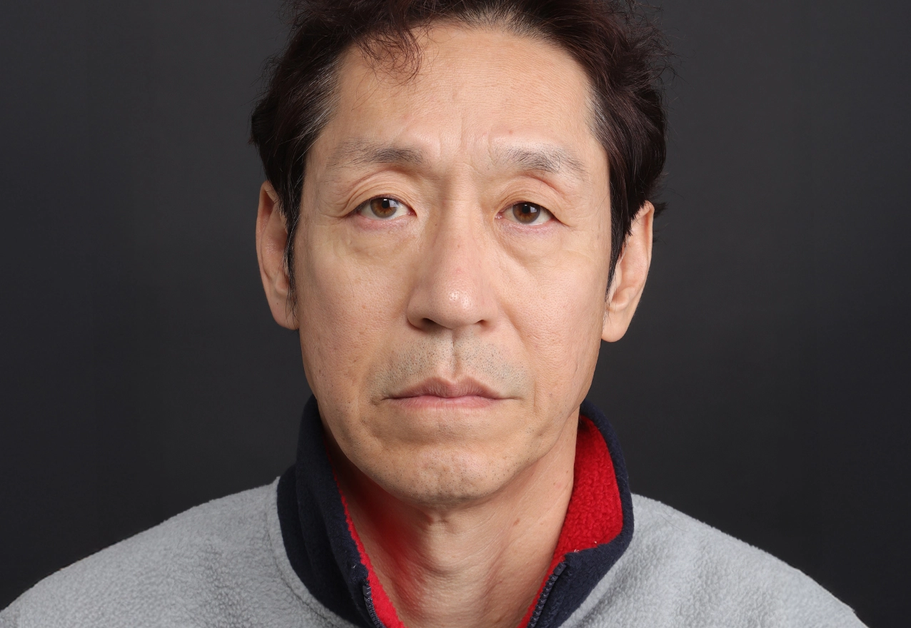 토탈 스킨 리뉴얼 참고 이미지: 시술 전 정면