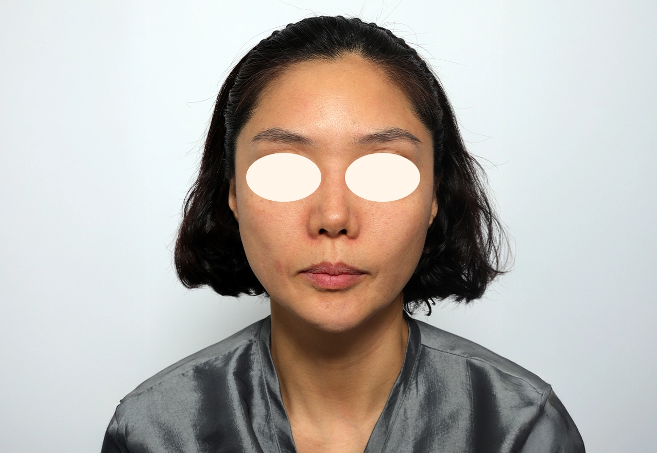 볼 모공 시술 전