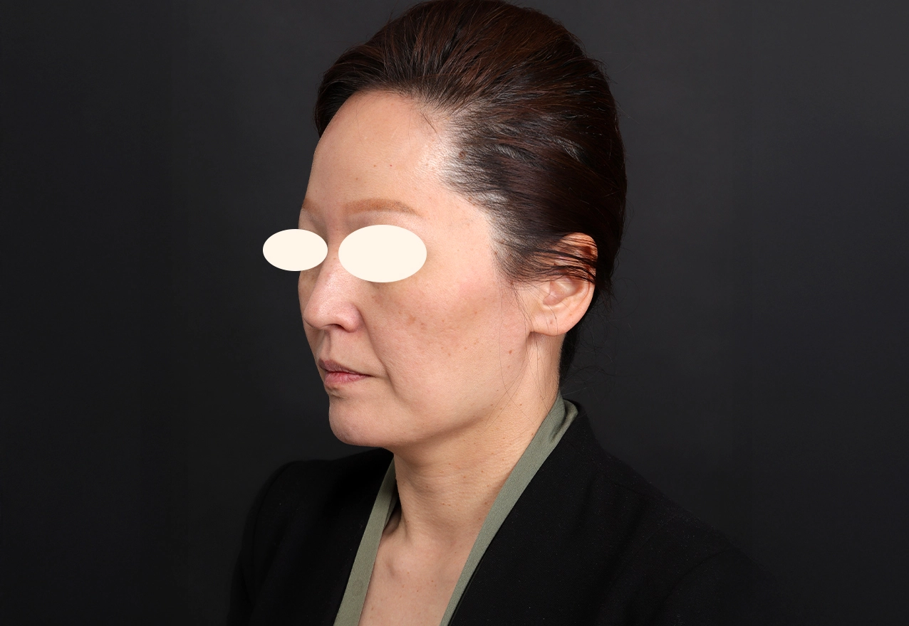 CASE 02 시술 전(참고)