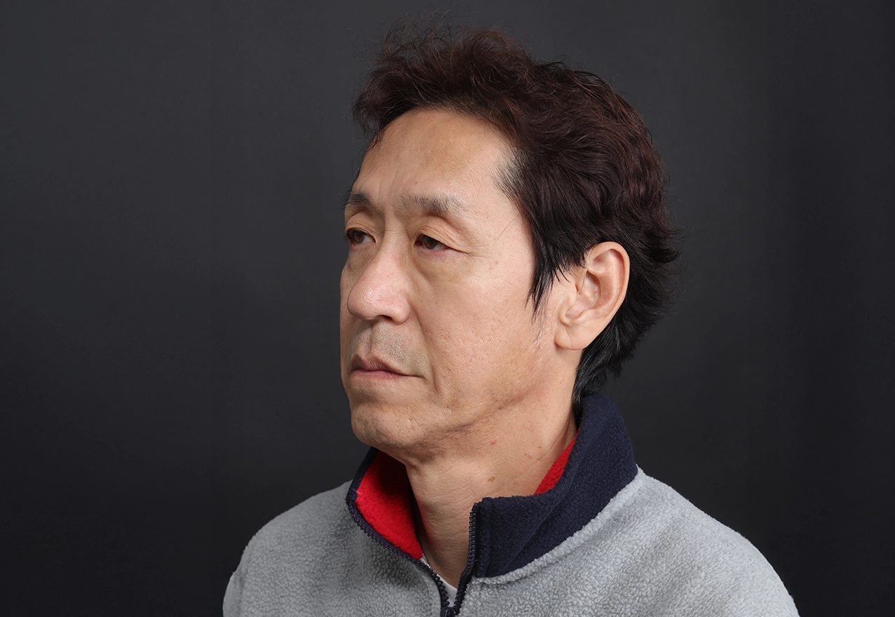 CASE 01 58세, 미시술·무수술, 시술 전(참고)