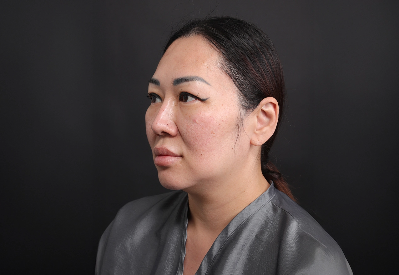 CASE 03 시술 전(참고)