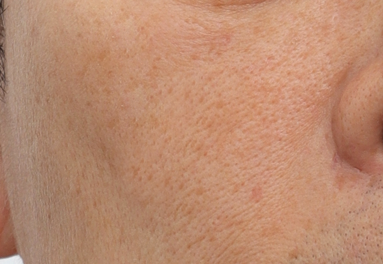 흉터 시술 전 케이스 1