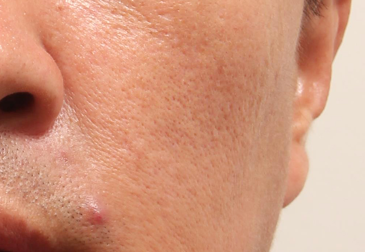 흉터 시술 전 케이스 2