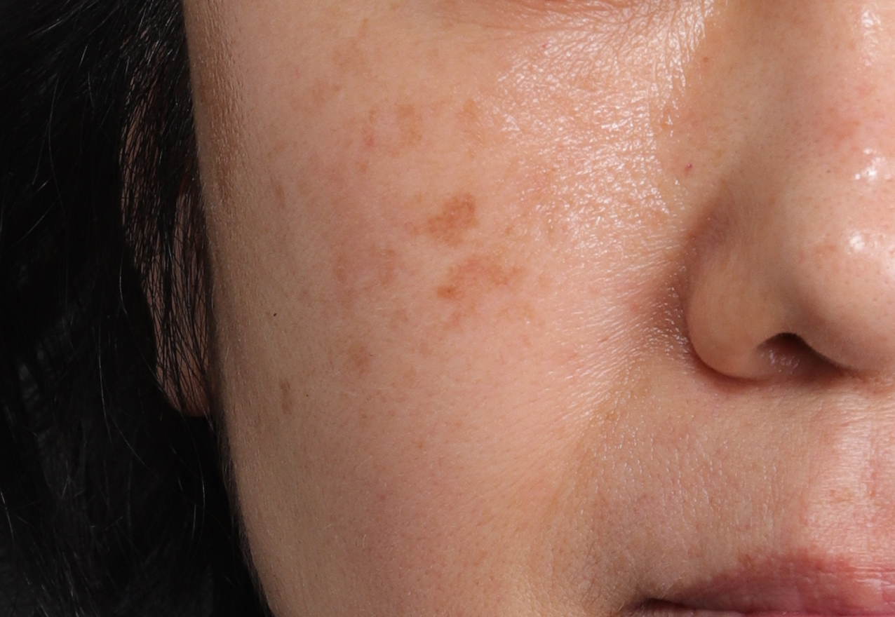 흉터 시술 전 케이스 3