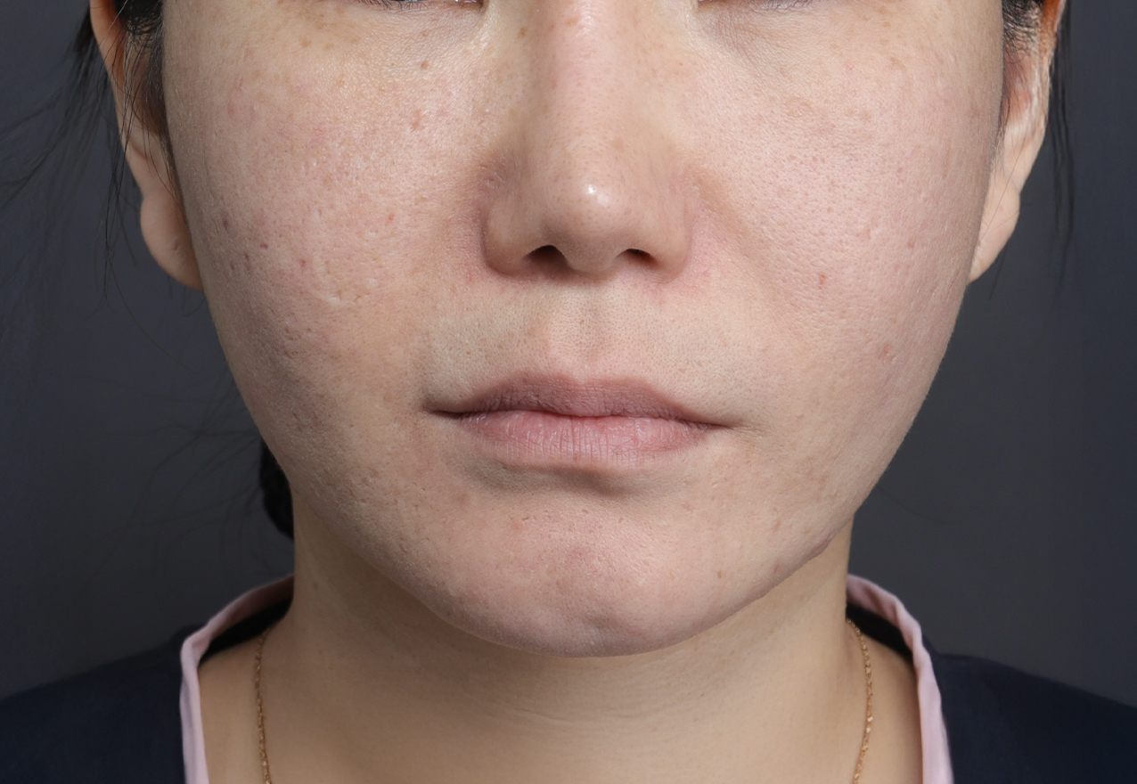 여드름 흉터 시술 전 (이미지 교체 예정)